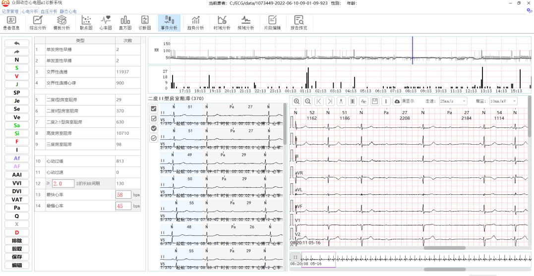 房室传导阻滞全面智能鉴别诊断